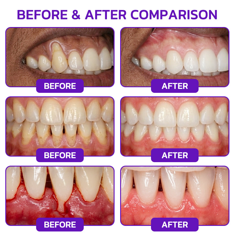 𝐍𝐚𝐭𝐫𝐚𝐯𝐨𝐫® VioCore Bee Venom Gingivitis & Periodontitis Treatment Toothpaste