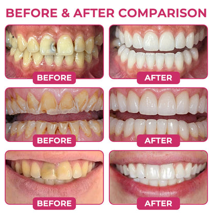 🔥Natravor® DenPerm Cavity-Repair Natural Enamel Filling Gel