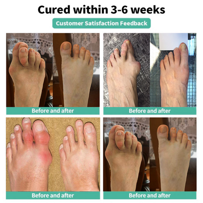 🏅Natravor® Relief Botanical Bunion Comfort Patcht👠💃（Physical Stretch Support + Botanical Comfort Formula)a