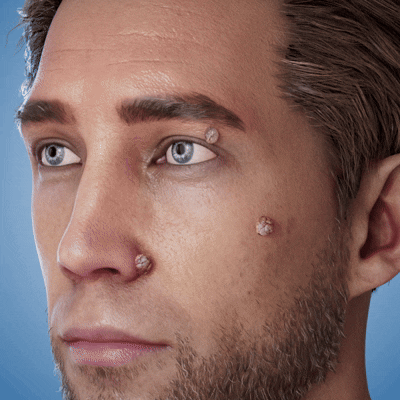💖TopSpire® 2-in-1 Microneedle & Hydrocolloid Patch | Targeted Solution for Raised Moles, Acne, Flat Warts & Skin Tags | Helps Improve the Appearance of Fine Lines, Scars & Skin Imperfections | Invisible Star Pimple Patches for Face & Body