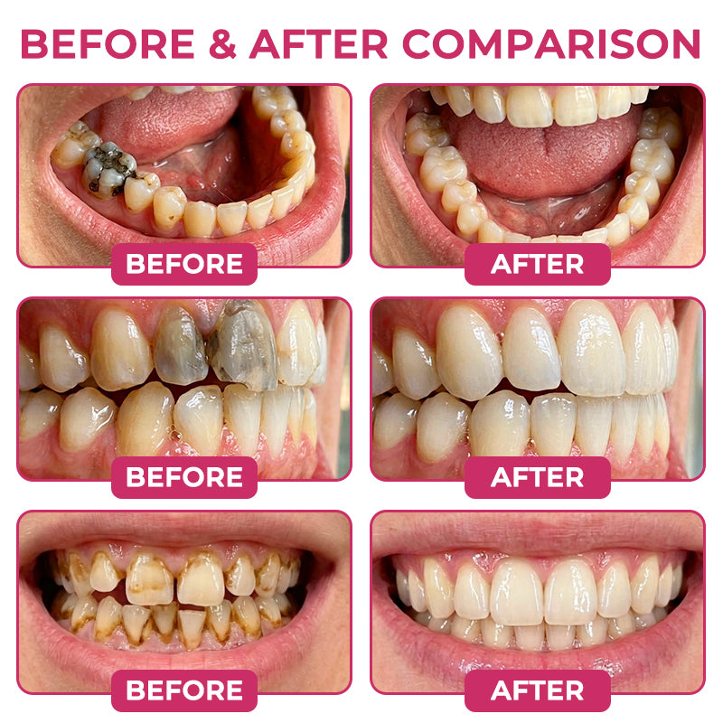 🔥Natravor® DenPerm Cavity-Repair Natural Enamel Filling Gel