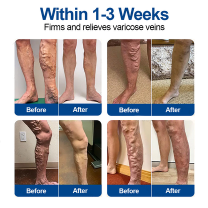 🇺🇸👨‍⚕️🦵✅𝐍𝐚𝐭𝐫𝐚𝐯𝐨𝐫® VeinTarget Microneedle Patch⚡Instant Relief, Long-Term Results