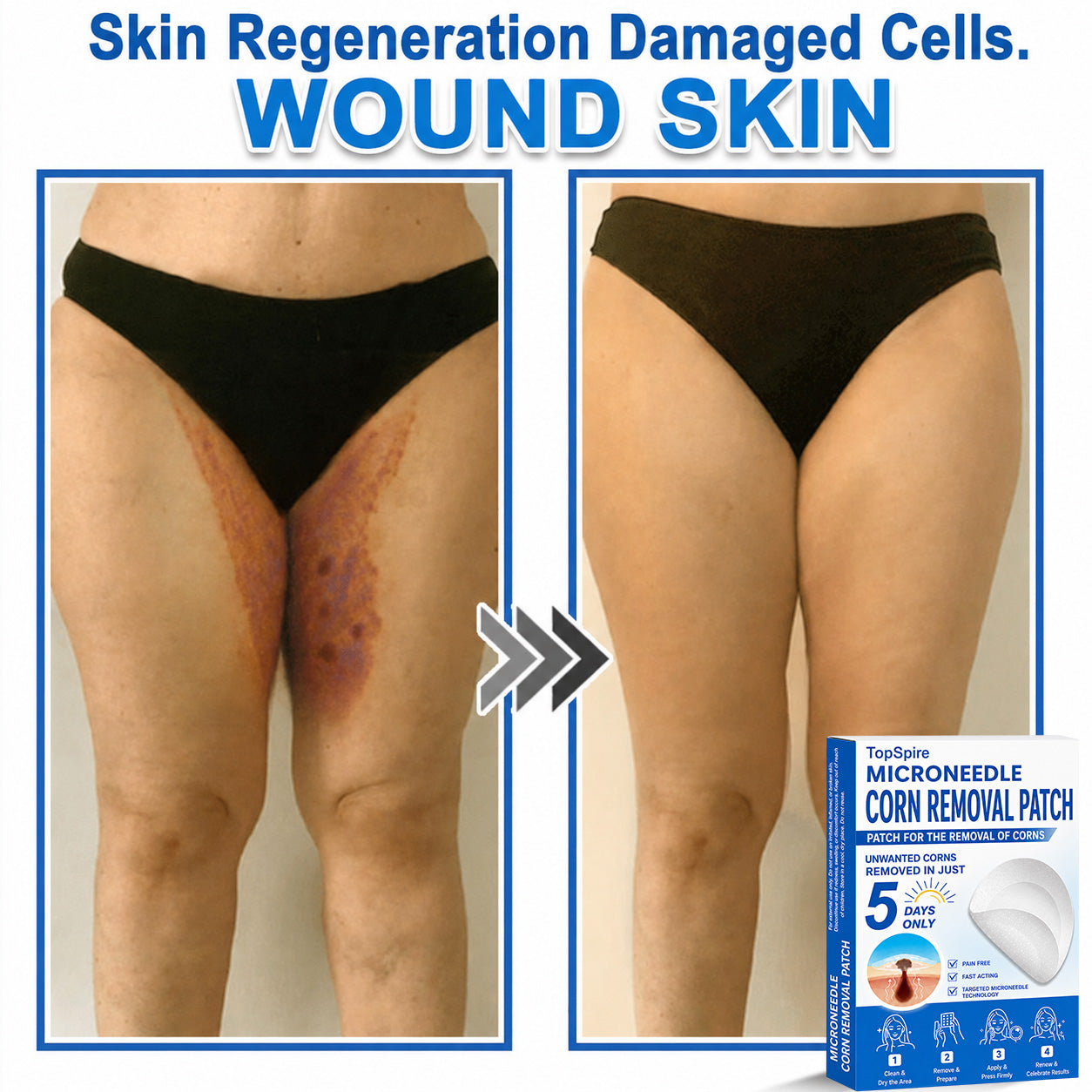 💖TopSpire® 2-in-1 Microneedle & Hydrocolloid Patch | Targeted Solution for Raised Moles, Acne, Flat Warts & Skin Tags | Helps Improve the Appearance of Fine Lines, Scars & Skin Imperfections | Invisible Star Pimple Patches for Face & Body
