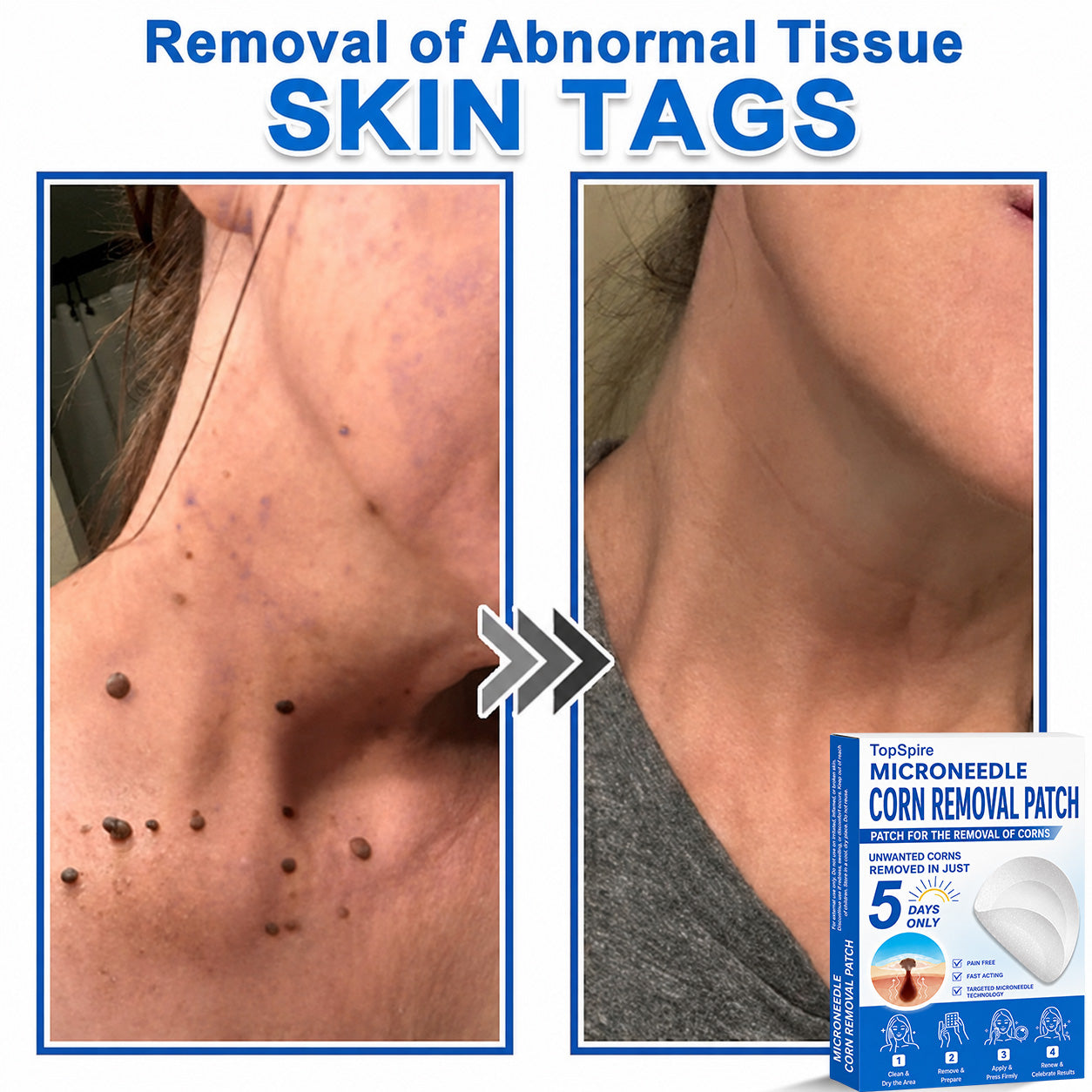 💖TopSpire® 2-in-1 Microneedle & Hydrocolloid Patch | Targeted Solution for Raised Moles, Acne, Flat Warts & Skin Tags | Helps Improve the Appearance of Fine Lines, Scars & Skin Imperfections | Invisible Star Pimple Patches for Face & Body