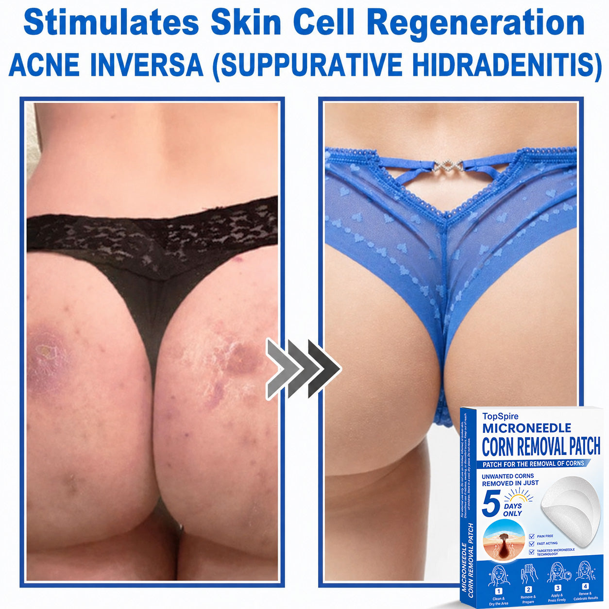 💖TopSpire® 2-in-1 Microneedle & Hydrocolloid Patch | Targeted Solution for Raised Moles, Acne, Flat Warts & Skin Tags | Helps Improve the Appearance of Fine Lines, Scars & Skin Imperfections | Invisible Star Pimple Patches for Face & Body