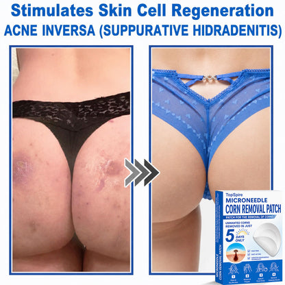 💖TopSpire® 2-in-1 Microneedle & Hydrocolloid Patch | Targeted Solution for Raised Moles, Acne, Flat Warts & Skin Tags | Helps Improve the Appearance of Fine Lines, Scars & Skin Imperfections | Invisible Star Pimple Patches for Face & Body