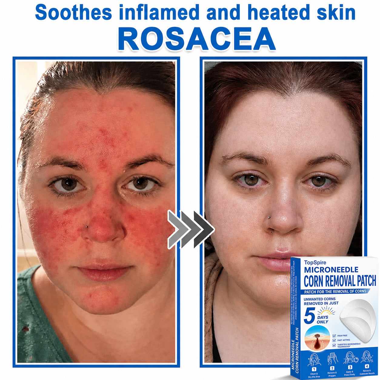 💖TopSpire® 2-in-1 Microneedle & Hydrocolloid Patch | Targeted Solution for Raised Moles, Acne, Flat Warts & Skin Tags | Helps Improve the Appearance of Fine Lines, Scars & Skin Imperfections | Invisible Star Pimple Patches for Face & Body