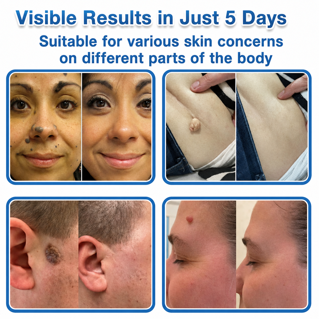 💖TopSpire® 2-in-1 Microneedle & Hydrocolloid Patch | Targeted Solution for Raised Moles, Acne, Flat Warts & Skin Tags | Helps Improve the Appearance of Fine Lines, Scars & Skin Imperfections | Invisible Star Pimple Patches for Face & Body