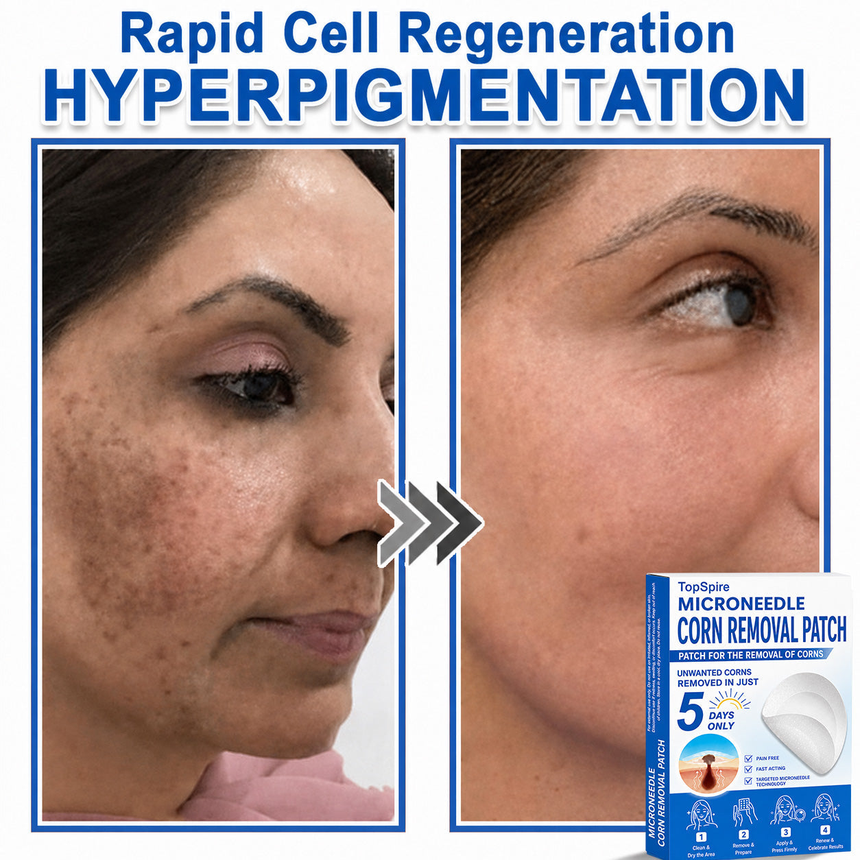 💖TopSpire® 2-in-1 Microneedle & Hydrocolloid Patch | Targeted Solution for Raised Moles, Acne, Flat Warts & Skin Tags | Helps Improve the Appearance of Fine Lines, Scars & Skin Imperfections | Invisible Star Pimple Patches for Face & Body