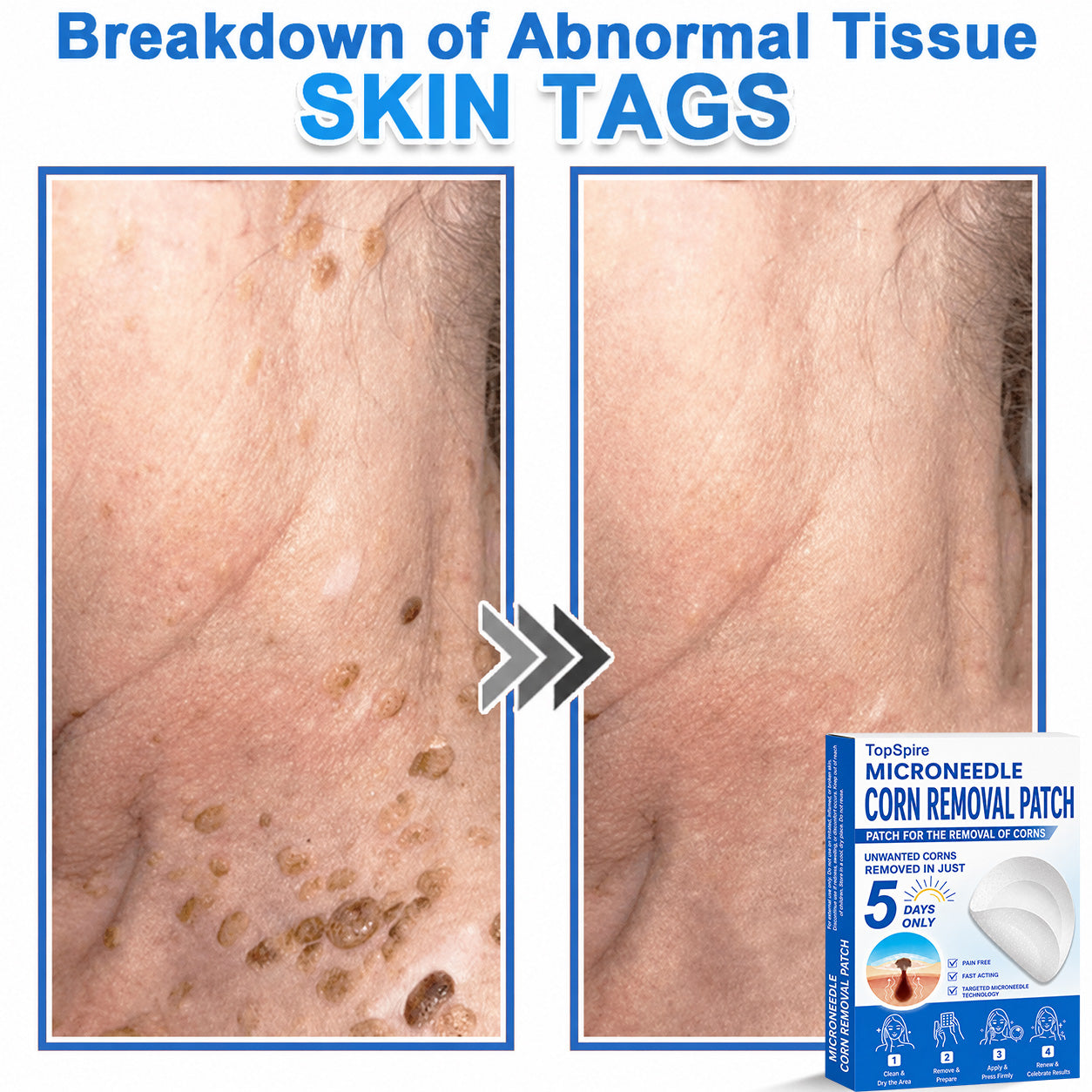 💖TopSpire® 2-in-1 Microneedle & Hydrocolloid Patch | Targeted Solution for Raised Moles, Acne, Flat Warts & Skin Tags | Helps Improve the Appearance of Fine Lines, Scars & Skin Imperfections | Invisible Star Pimple Patches for Face & Body