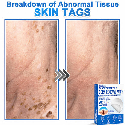 💖TopSpire® 2-in-1 Microneedle & Hydrocolloid Patch | Targeted Solution for Raised Moles, Acne, Flat Warts & Skin Tags | Helps Improve the Appearance of Fine Lines, Scars & Skin Imperfections | Invisible Star Pimple Patches for Face & Body