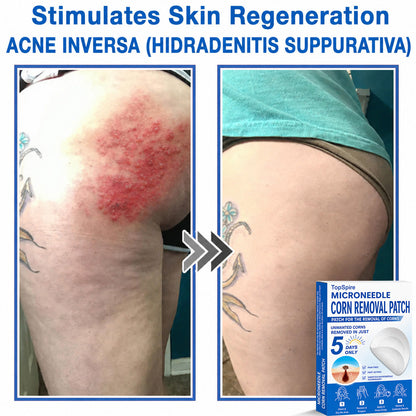 💖TopSpire® 2-in-1 Microneedle & Hydrocolloid Patch | Targeted Solution for Raised Moles, Acne, Flat Warts & Skin Tags | Helps Improve the Appearance of Fine Lines, Scars & Skin Imperfections | Invisible Star Pimple Patches for Face & Body