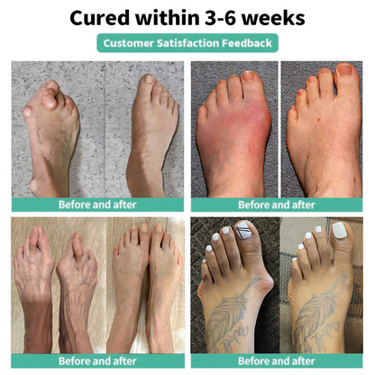 🏅Natravor® Relief Botanical Bunion Comfort Patcht👠💃（Physical Stretch Support + Botanical Comfort Formula)a